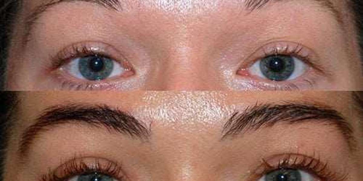 Eyebrows Restoration