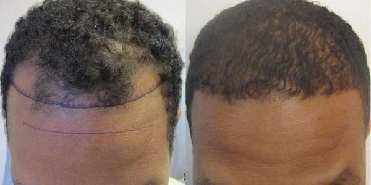 Hair Transplant for African American