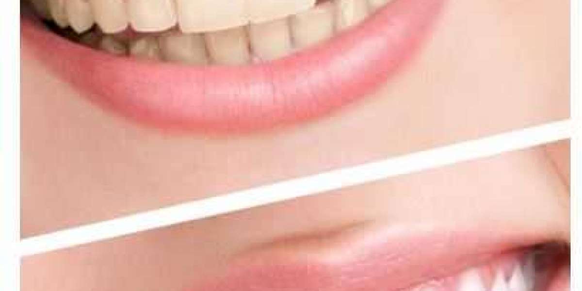 Best Teeth whitening service in Plano