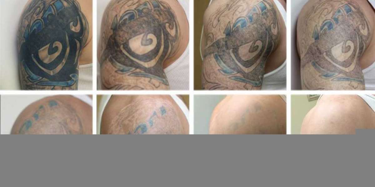 Everything You Need To Know About Laser Tattoo Removal Safety