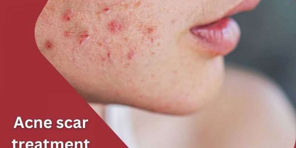 Scars Fading Away: Journey to Acne Scar Recovery