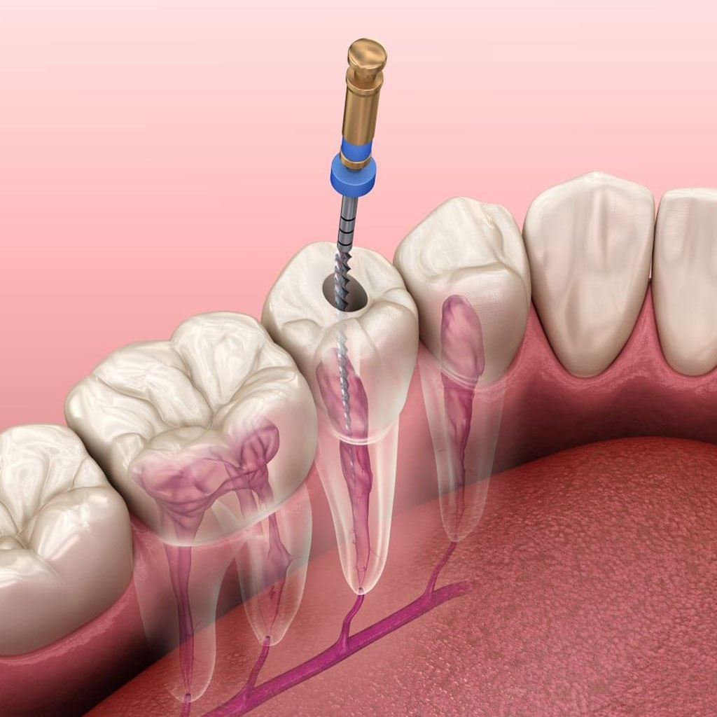Root Canal Treatment In Gurgaon | Root Canal Dentist - Dr Dabas