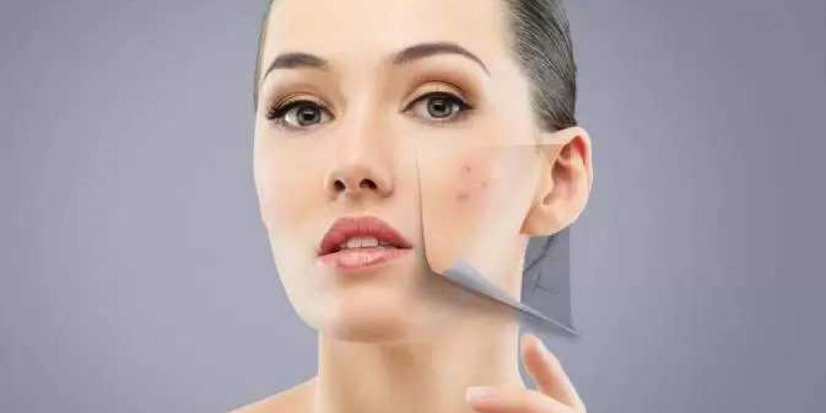Isotroin 20mg Acne Medication