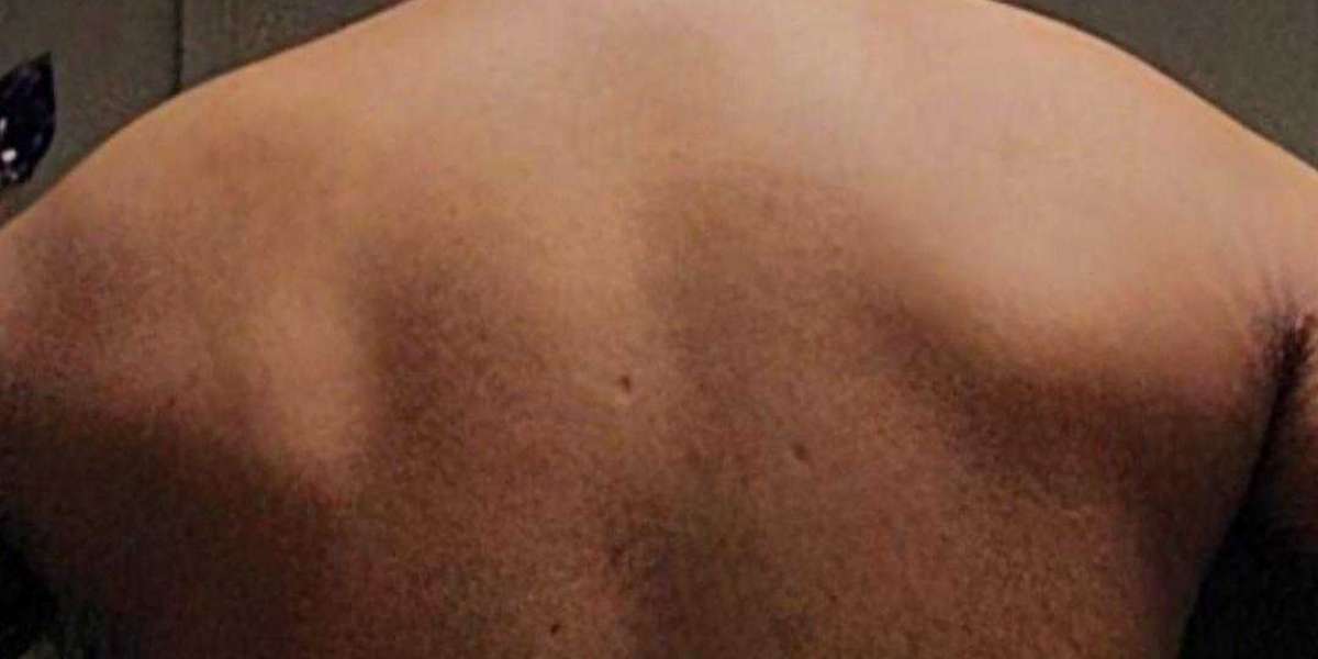 How to Fix Uneven Shoulders: Effective Exercises and Tips for Better Posture